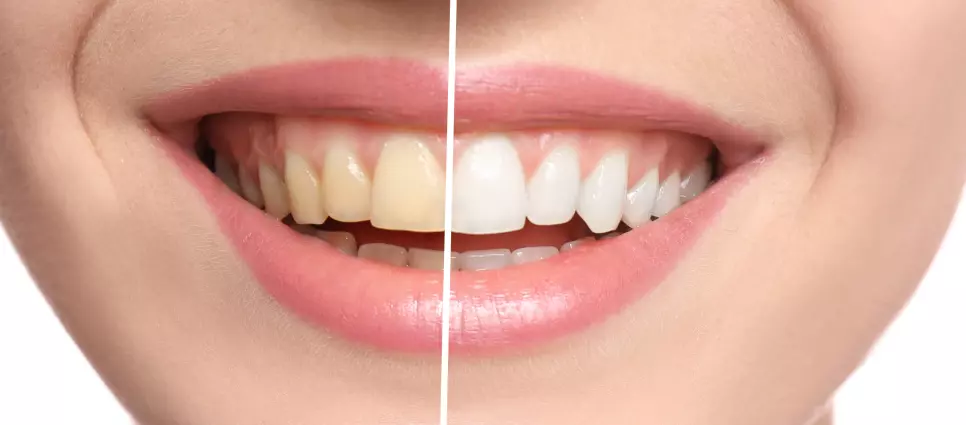 A man getting his teeth whitened.