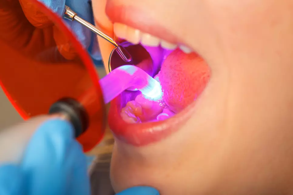 A person getting composite fillings installed.