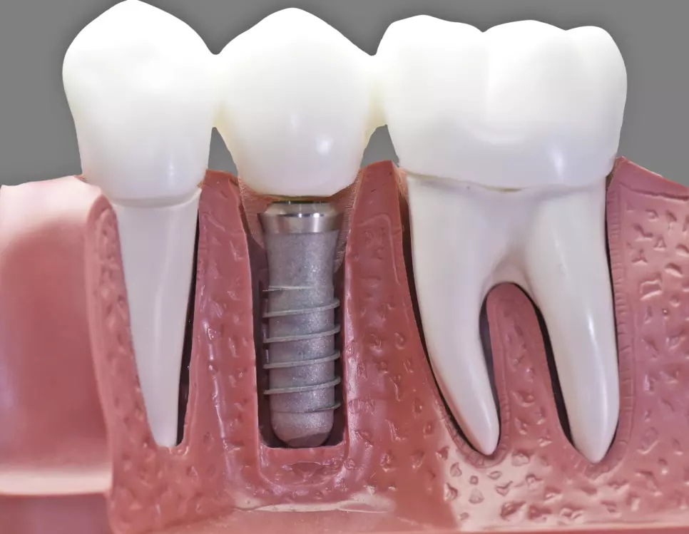 An implant crown.
